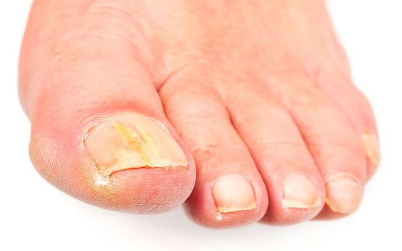 The cause of the fungus