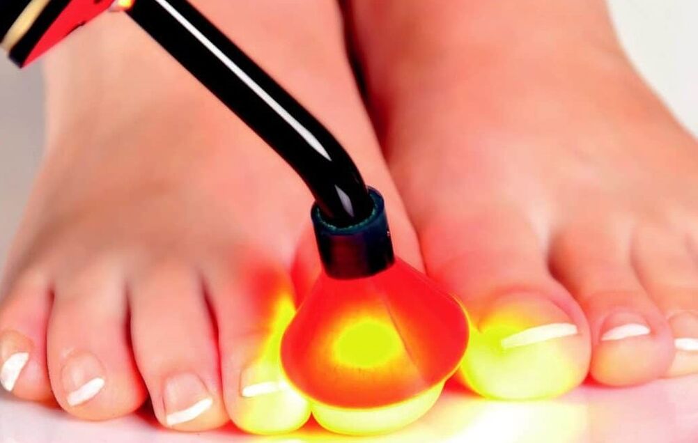 Nail plate laser treatment