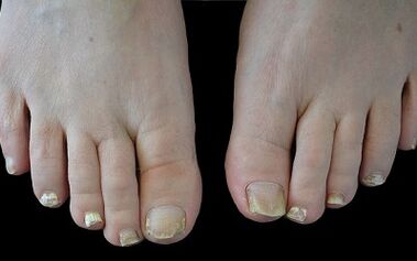 How to get rid of fungus in your fingers