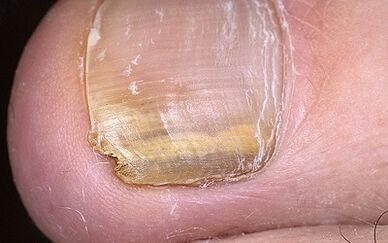 Manifestation of fungus in the toes