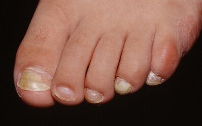 Reason -as a fungal appearance in the toes