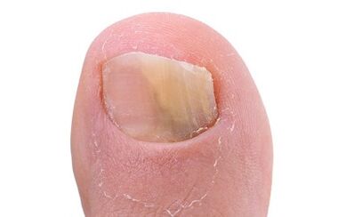 Symptoms of the presence of fungus in the toes