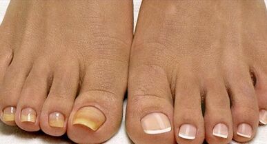 Fleet fungal treatment method