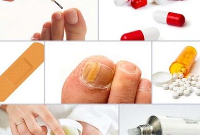 how to treat fungus on nails