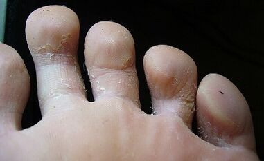 Like what a fungus on the feet and how to treat it