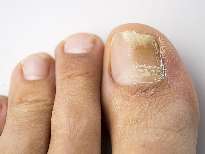 An early stage of fungus