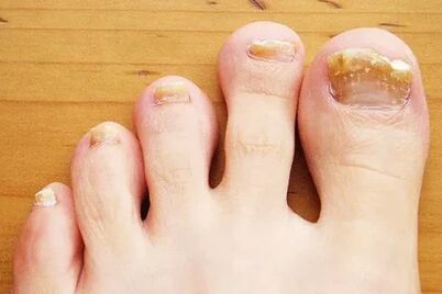 Nail fungus