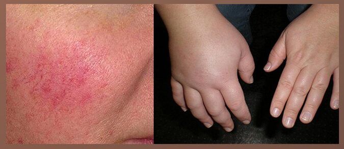 The side effects of drops