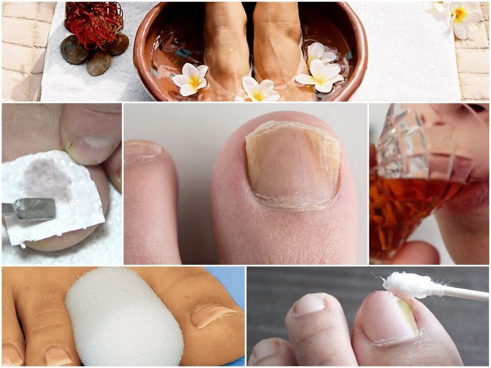 Nail fungal treatment