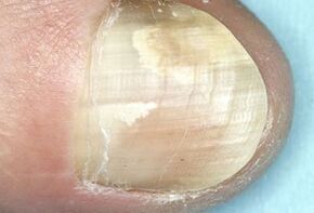 damage to the nail plate due to fungal infection