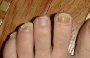 yellow nails because of fungus