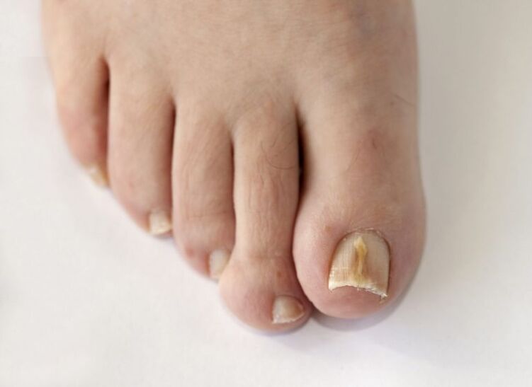 Toenail plate affected by fungus